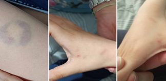 Άρτα: Διευθύντρια σχολείου δάγκωσε 11χρονο μαθητή ΑΜΕΑ