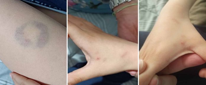 Άρτα: Διευθύντρια σχολείου δάγκωσε 11χρονο μαθητή ΑΜΕΑ Άρτα: Διευθύντρια σχολείου δάγκωσε 11χρονο μαθητή ΑΜΕΑ